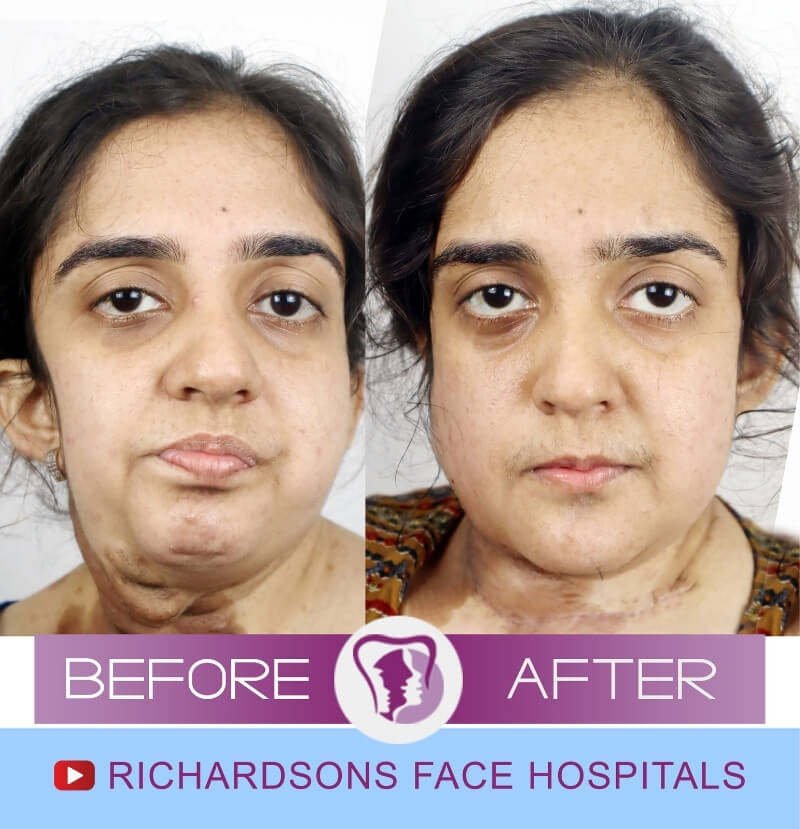 Bhargavi Jaw Surgery