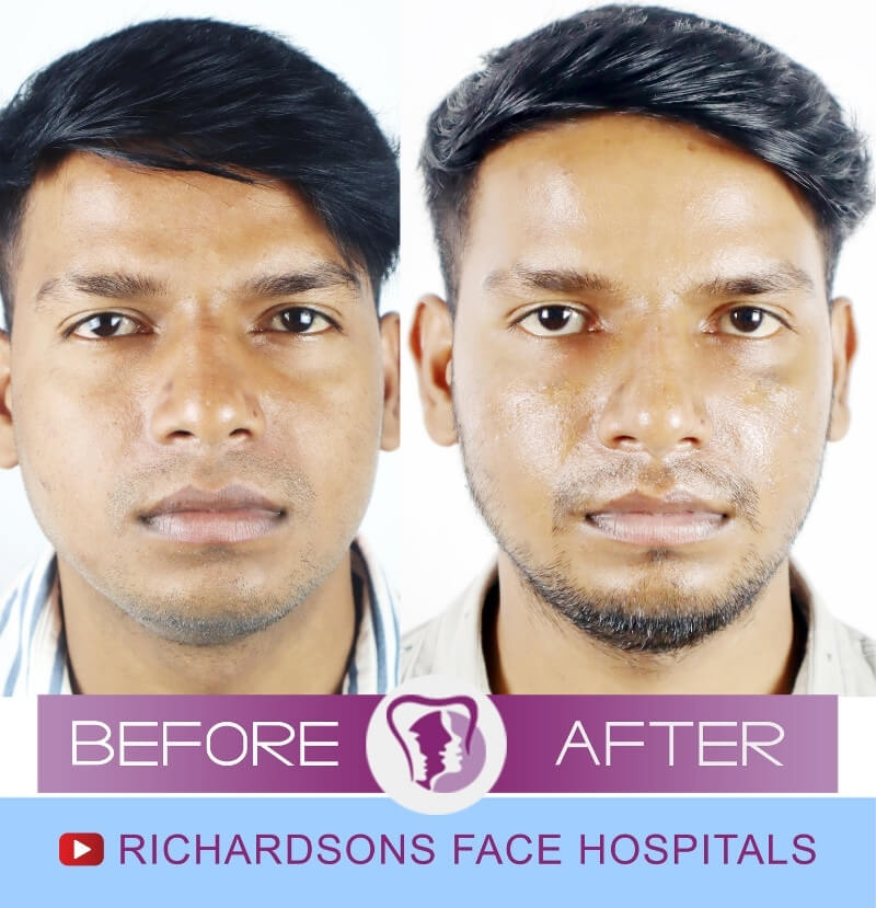 Chandan Rhinoplasty Surgery