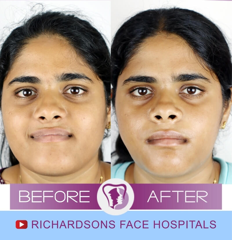 Deepika Bijaw Surgery