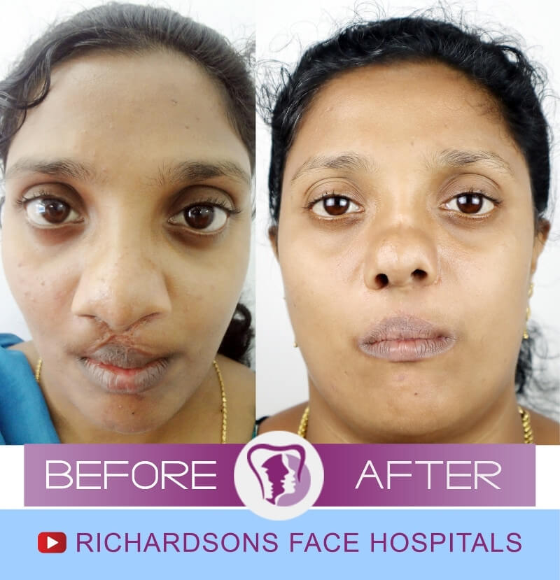 Geetha Rhinoplasty Surgery