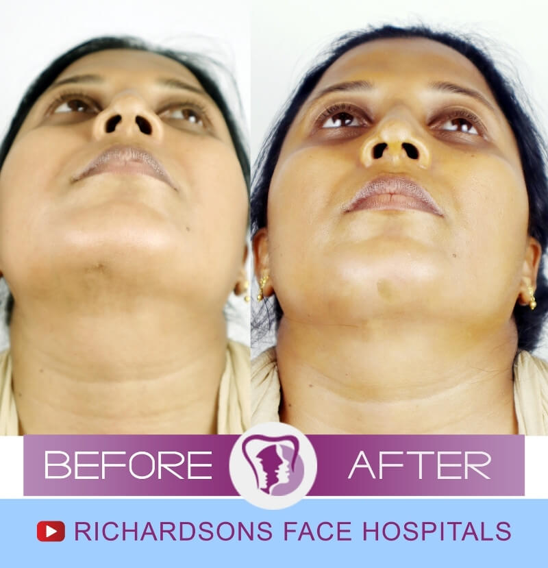 Geetha Scar Surgery