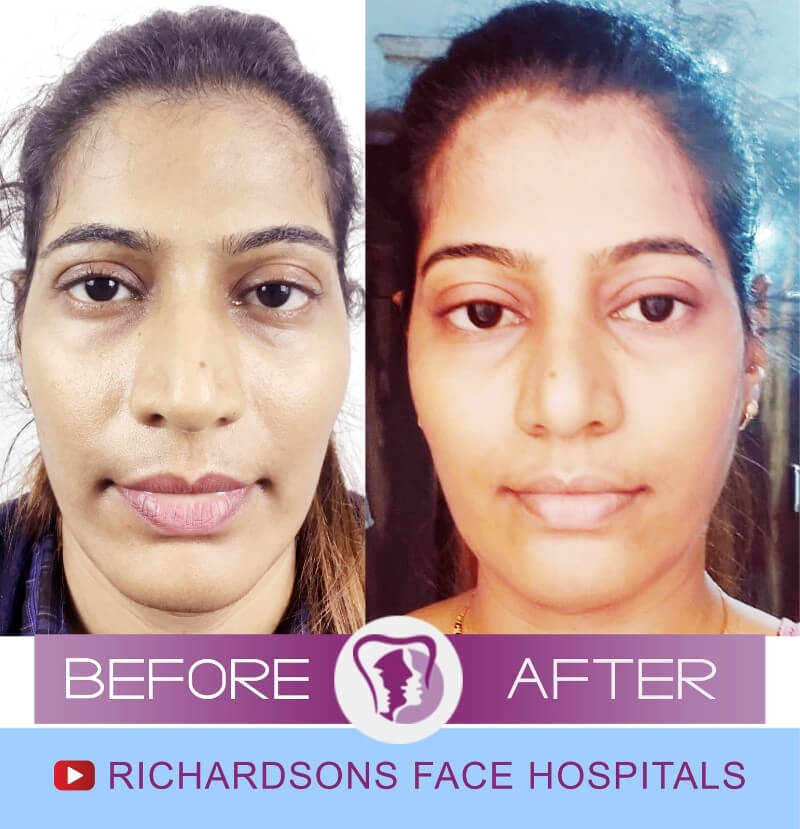 Jyothi Rhinoplasty Surgery