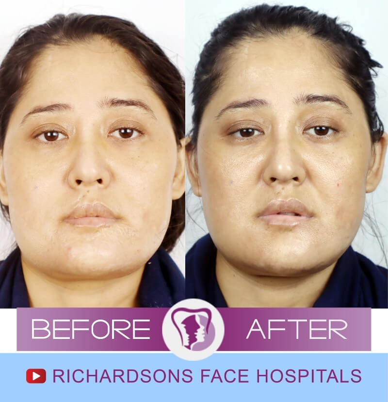 Kaushilya Rai Genioplasty Surgery