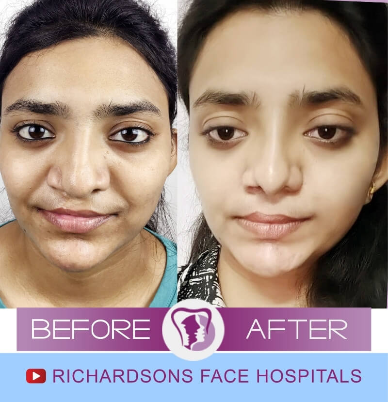 Keerthana Lip Reduction Surgery