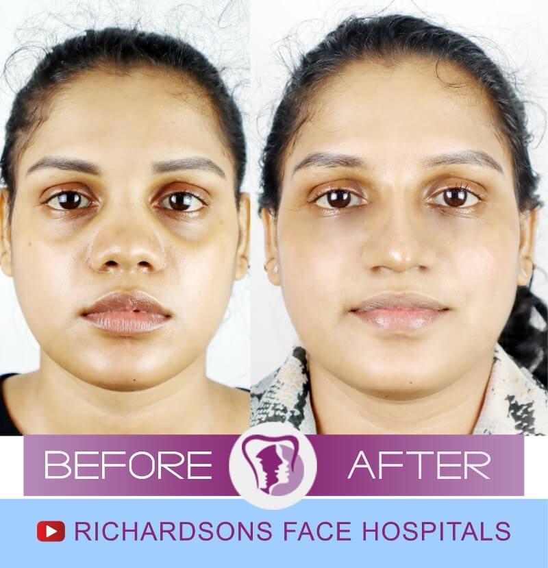 Krishnaveni Lip Reduction Surgery