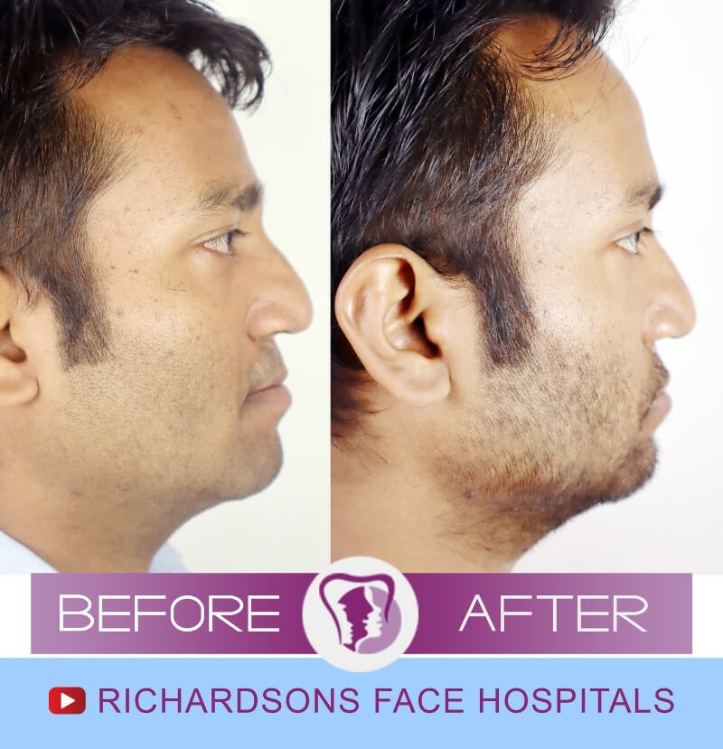 Lip Revision Surgery Ravi Pushpak