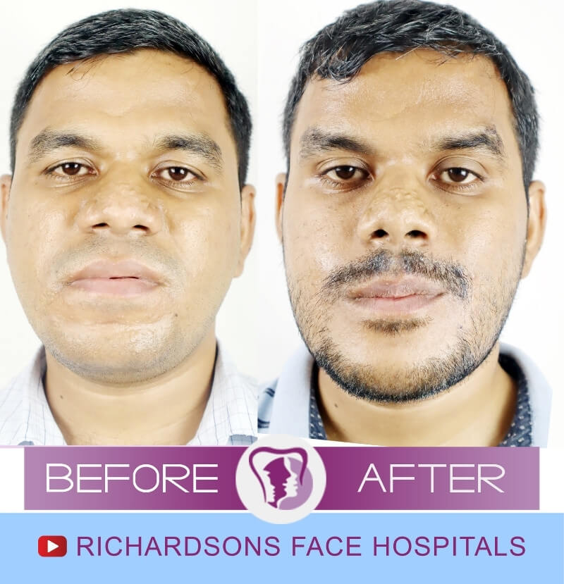 Mohammed Hyder Genioplasty Surgery