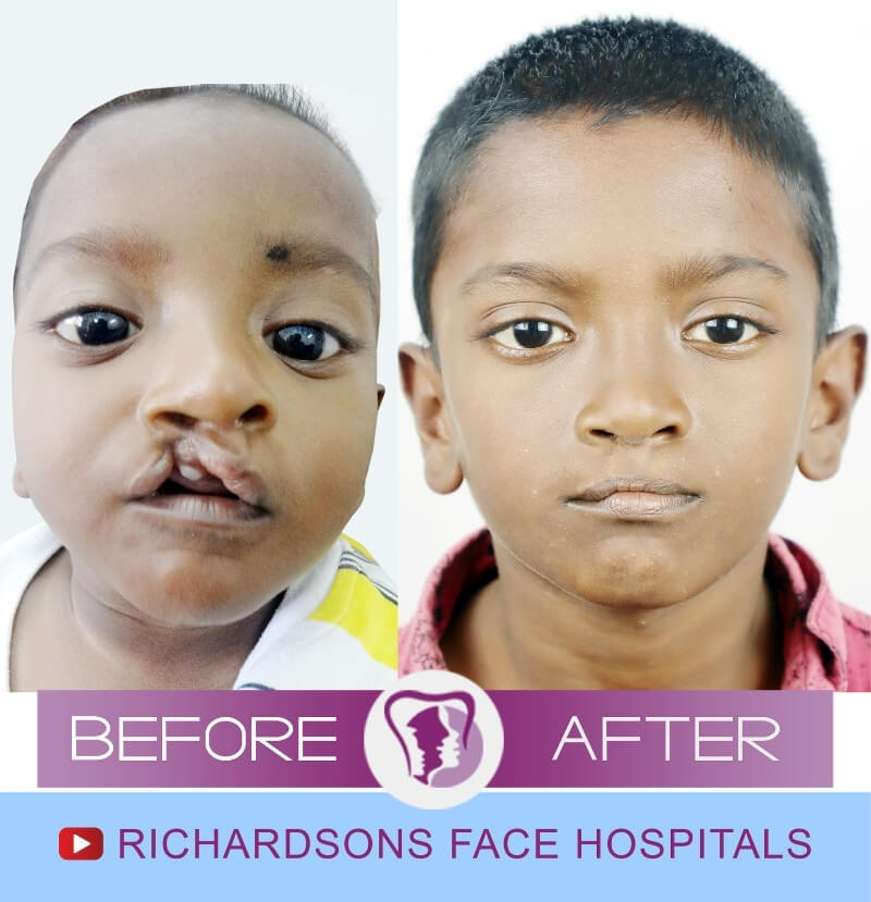 Mohammed Kabeer Cleft Lip Palate Surgery