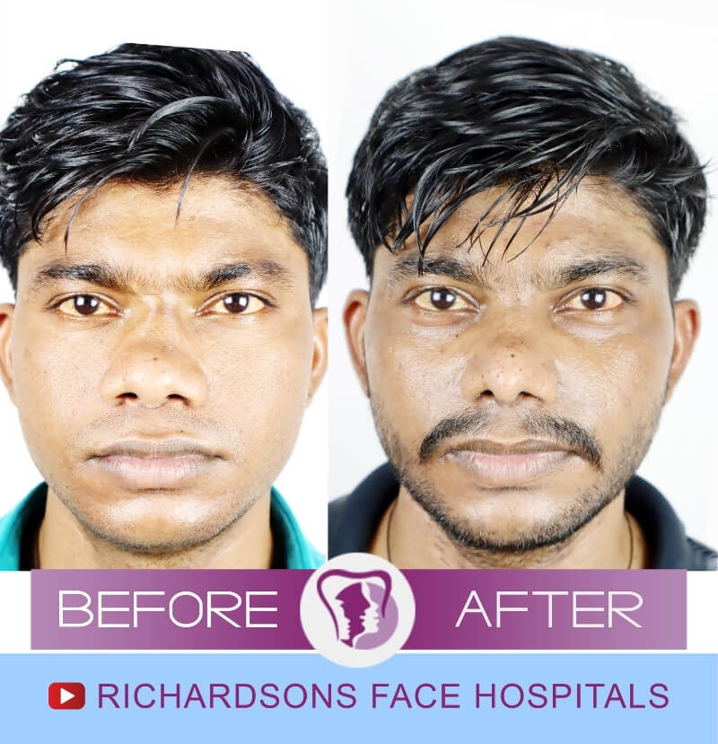 Naveen Rhinoplasty Surgery