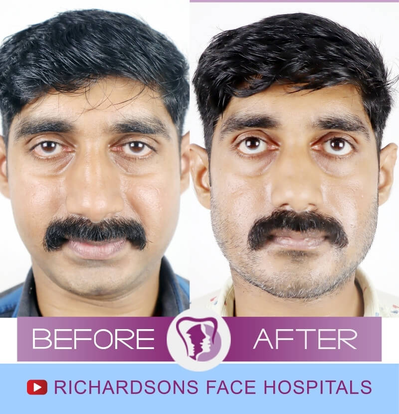 Prajith Jaw Surgery