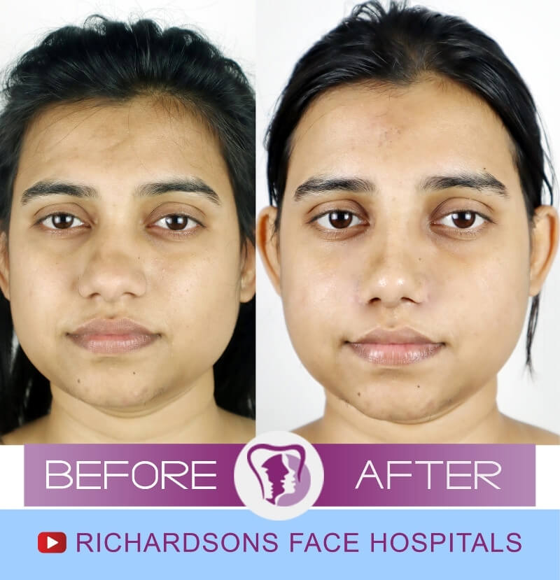 Priyanka Rhinoplasty Surgery