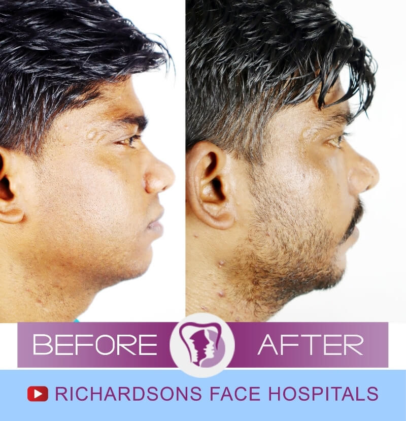 Rhinoplasty Surgery Naveen