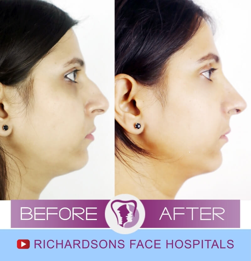 Rhinoplasty Surgery Sakshi