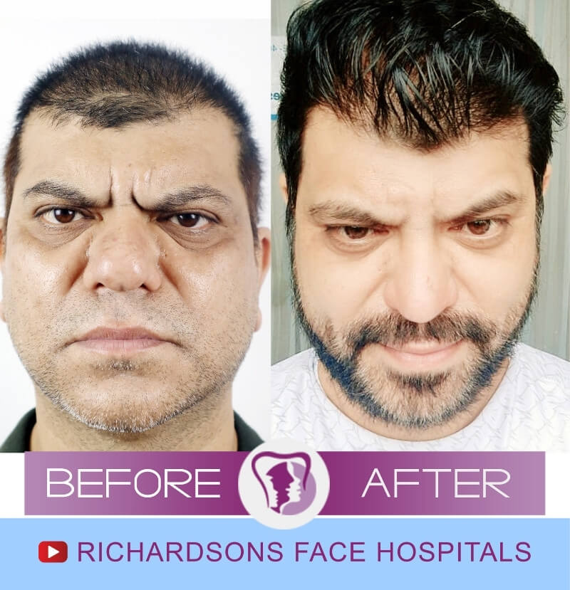 Rhinoplasty Surgery Shohan Singh