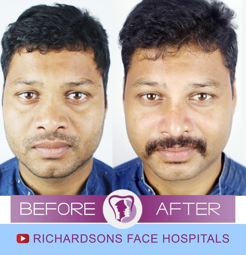 Sankar Murmu Rhinoplasty Surgery