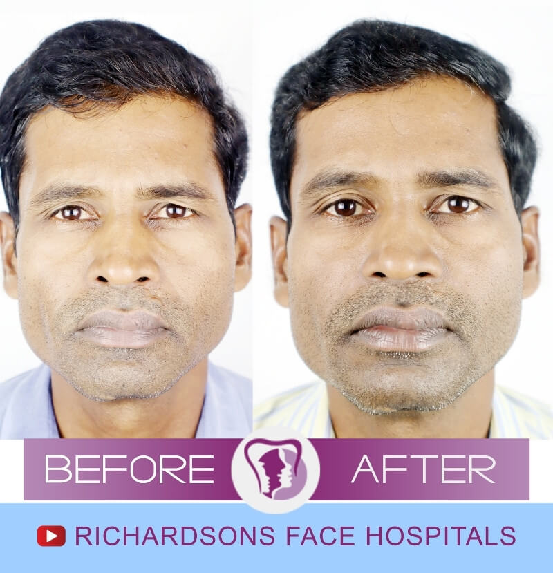 Sreehari Scar Surgery