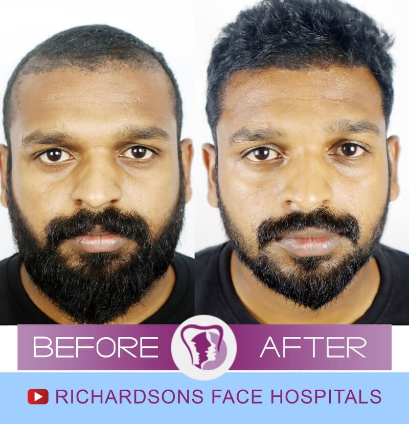 Hair Transplant - Richardson's Plastic Surgery Hospitals