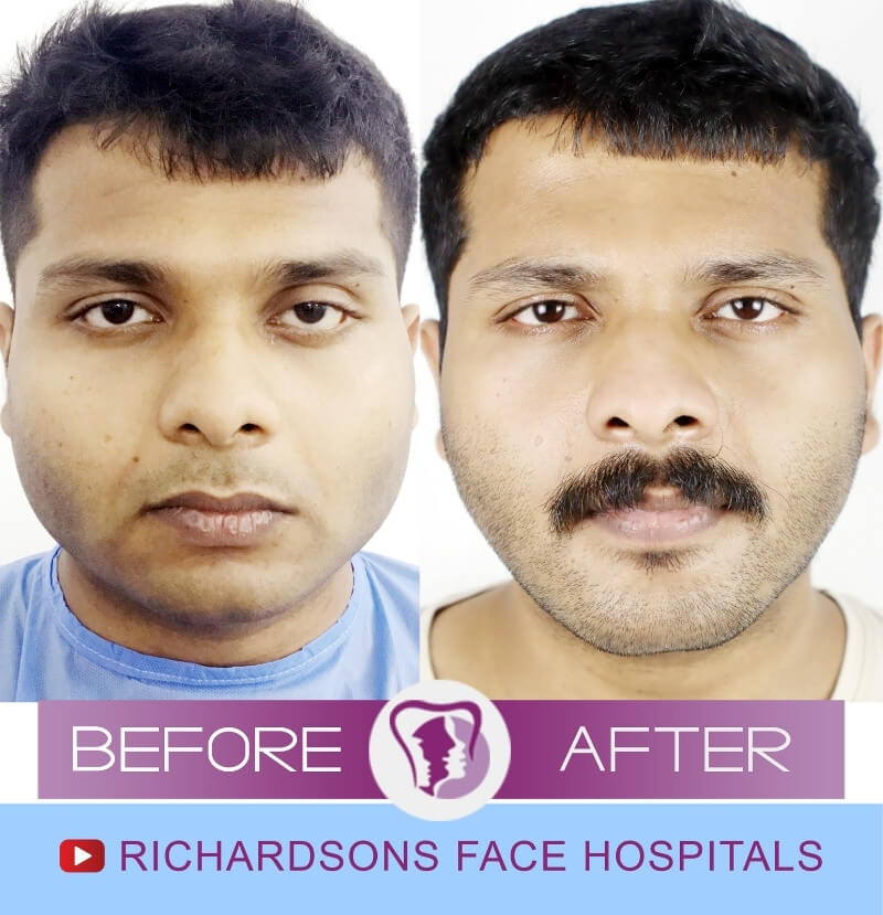 Vishnu Santhosh Genioplasty Surgery