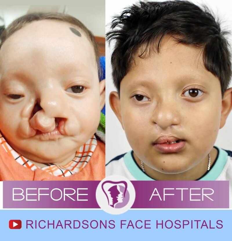 Aaryan Cleft Lip Palate Surgery