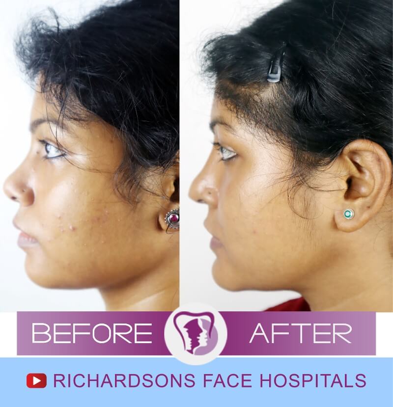 Anidita Face Makeover Surgery
