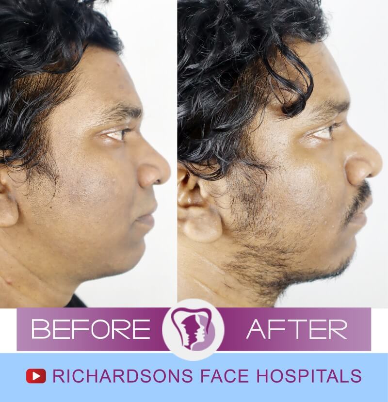 Facial Asymmetry Surgery Adarsh