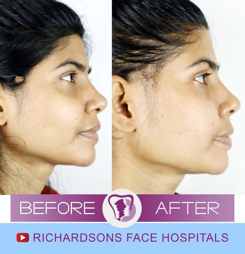 Facial Asymmetry Surgery Nilam