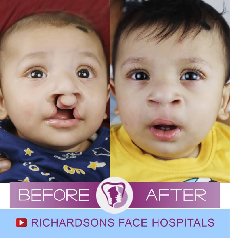 Ivaan Cleft Lip Palate Surgery