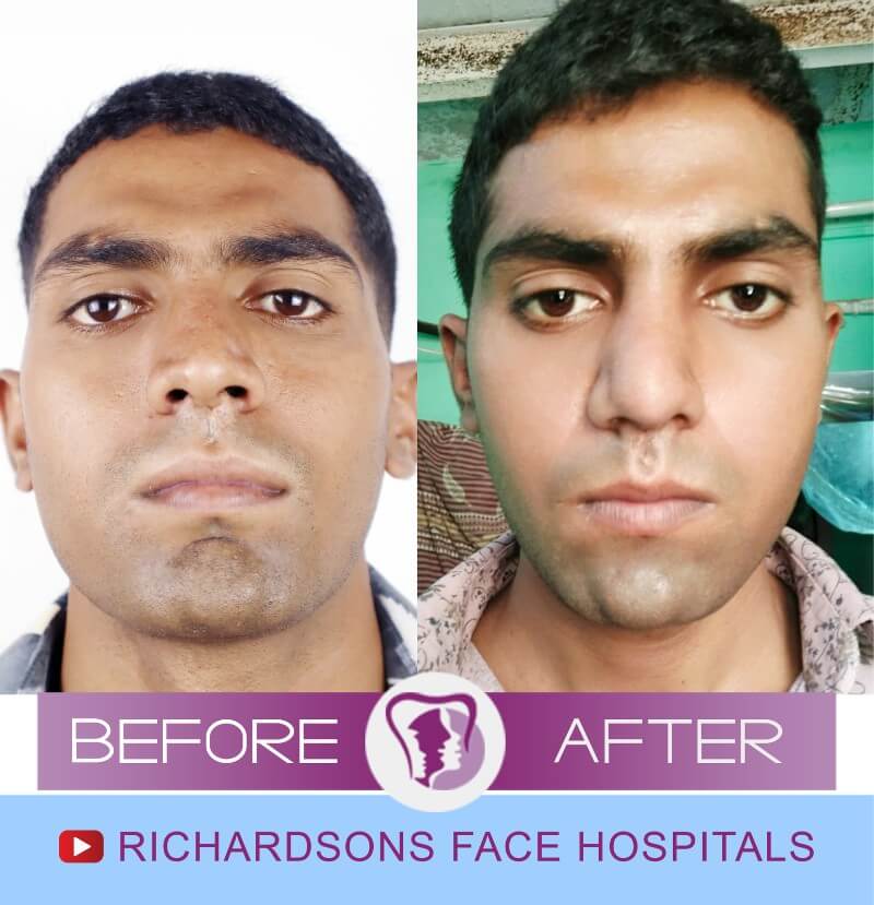 Karan Rhinoplasty Surgery