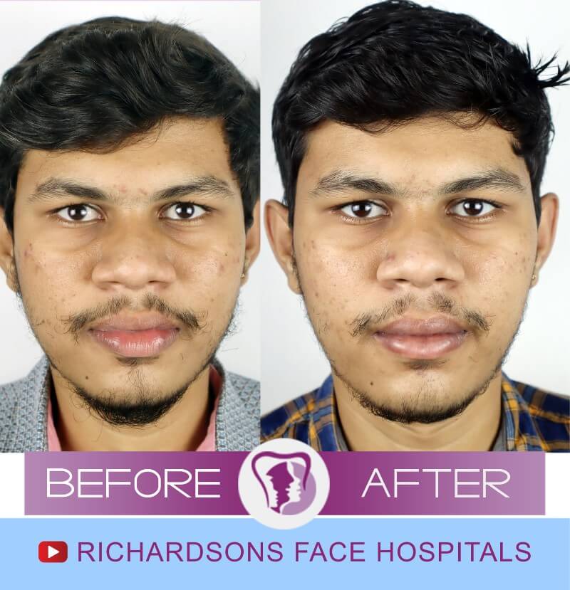 Lip Revision Surgery Vignesh