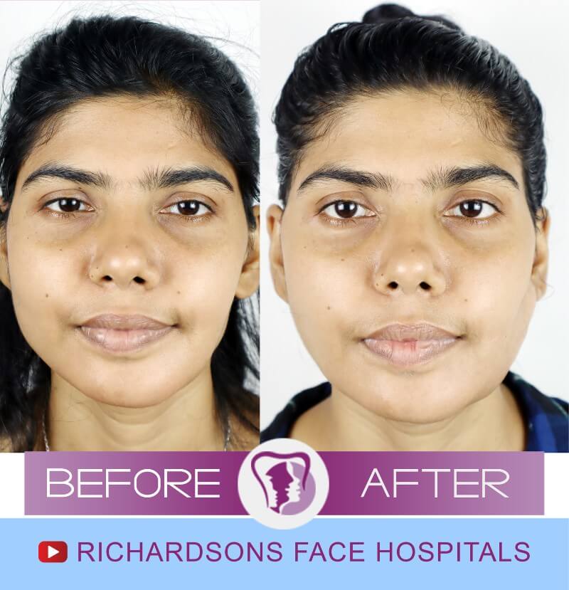 Nilam Facial Asymmetry Surgery