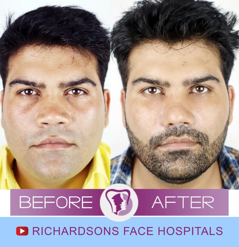 Rhinoplasty Surgery Amit Kumar