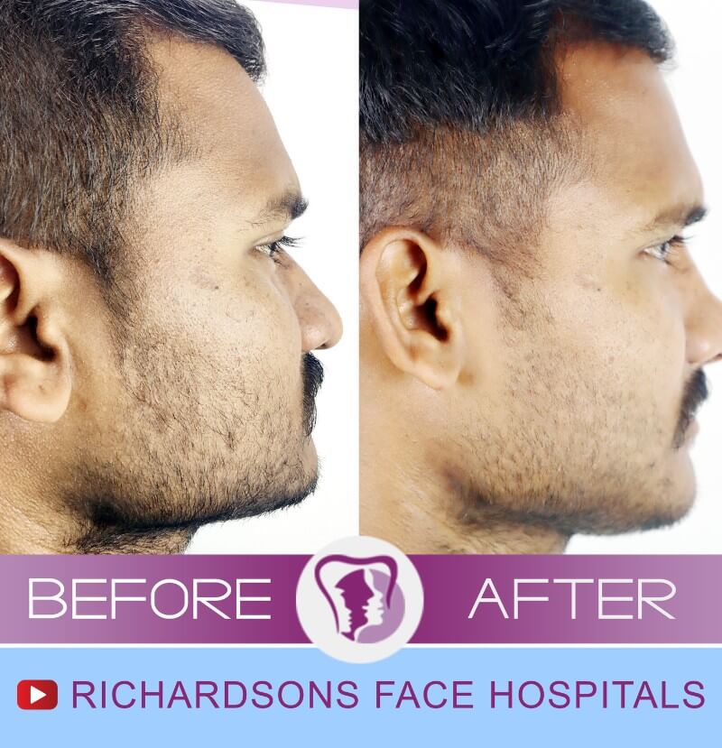 Rhinoplasty Surgery Prem Sagar