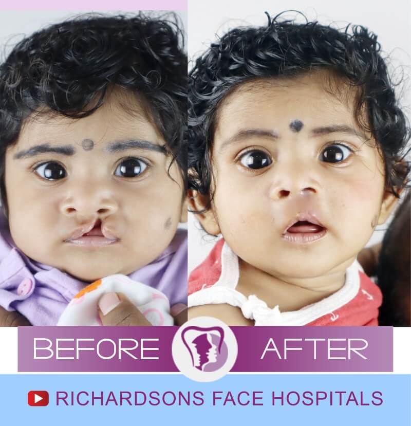 Swareopa Rani Cleft Lip Palate Surgery