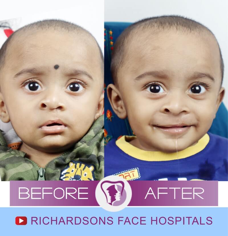 Aadhinath Cleft Lip Palate Surgery