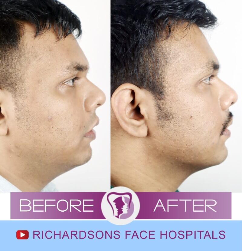 Adarsh Jaw Surgery Side View