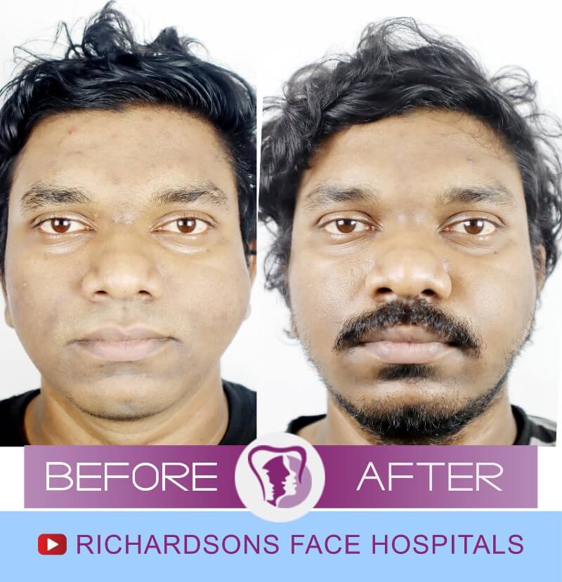 Adharsh Facial Asymmetry Surgery