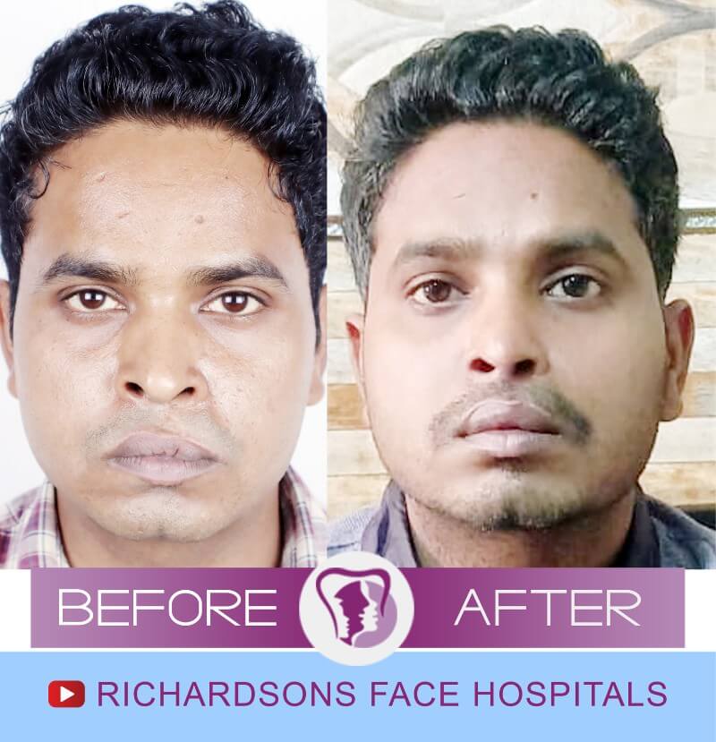 Atul Cleft Lip Palate Surgery