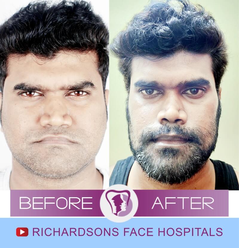 Boopathi Bijaw Surgery