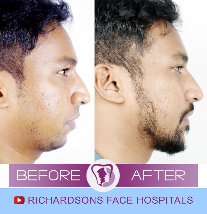 Chin Surgery Rajnikant