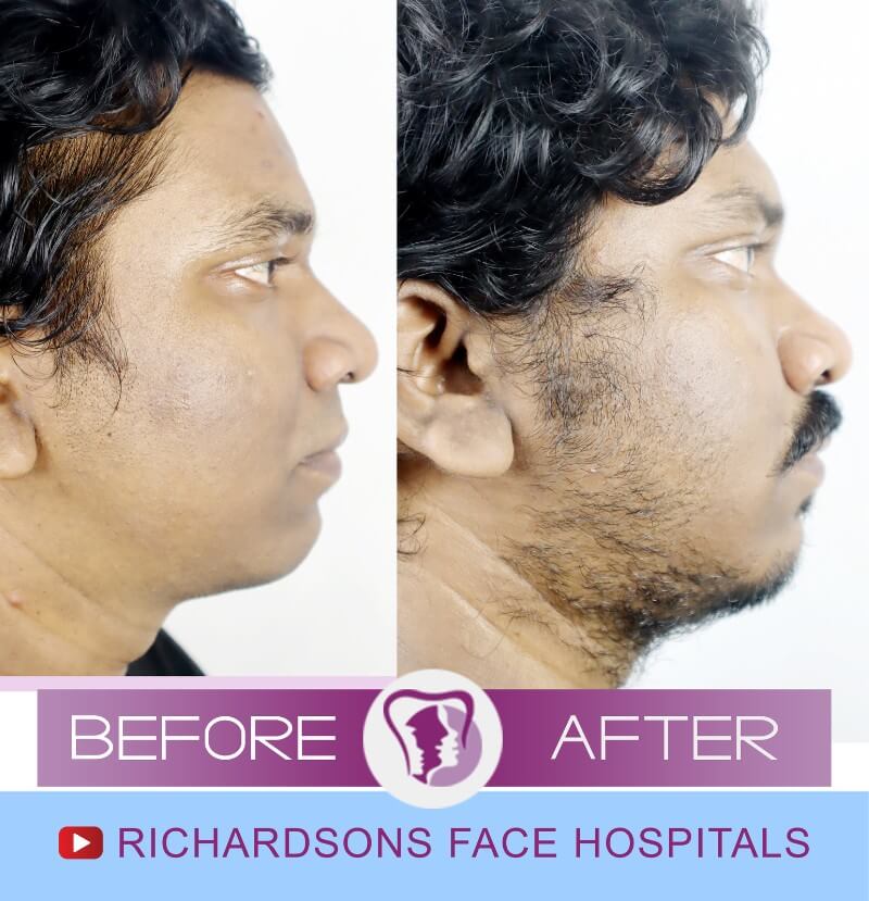 Facial Asymmetry Surgery Adharsh