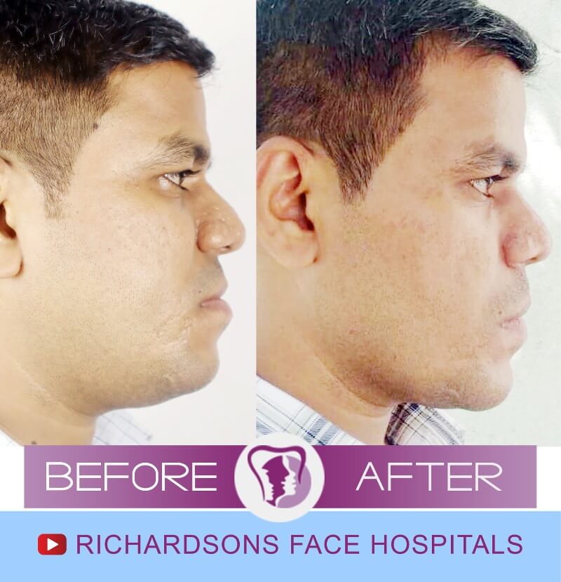 Facial Asymmetry Surgery Mohammed Hyder