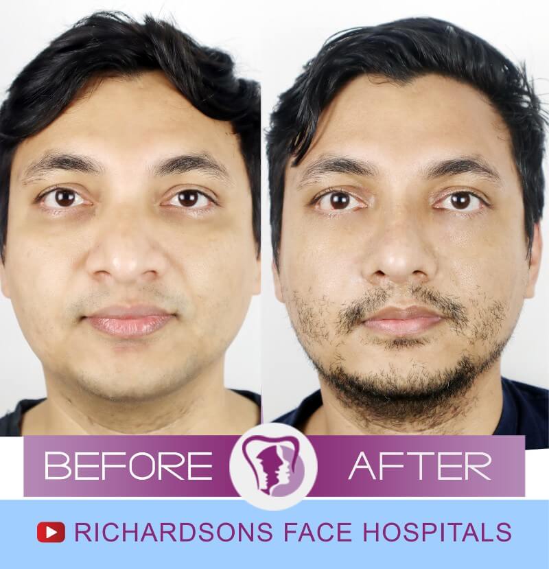 Gaurab Rhinoplasty Surgery