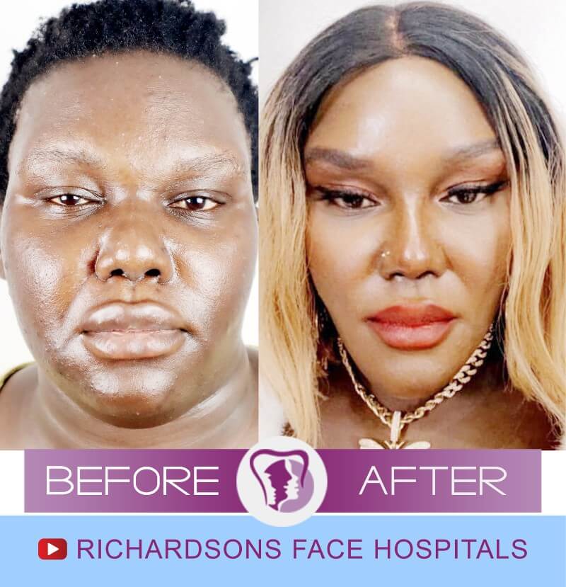 Kandice Face Makeover Surgery
