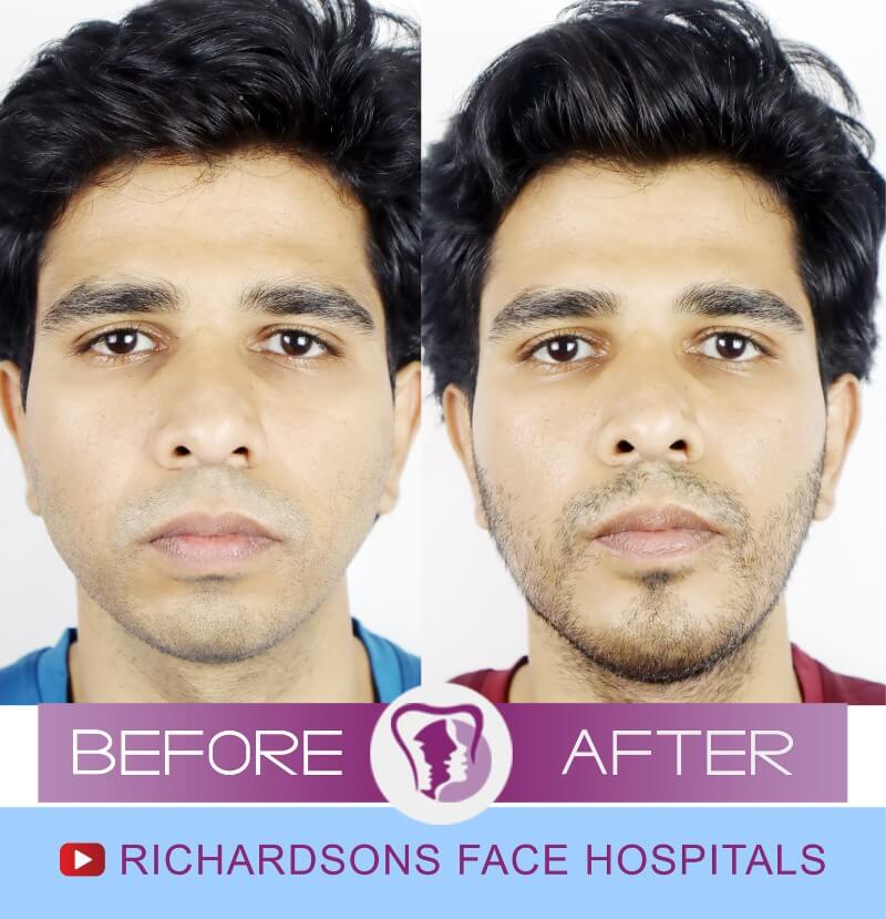 Naresh Genioplasty Surgery