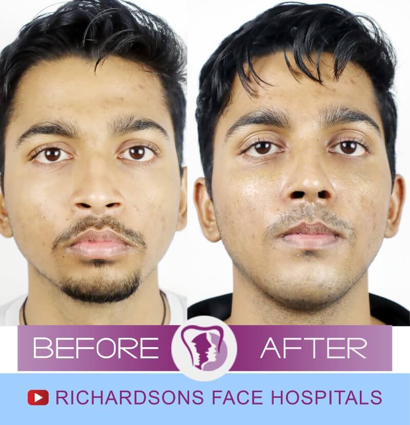 Om Singh Genioplasty Surgery