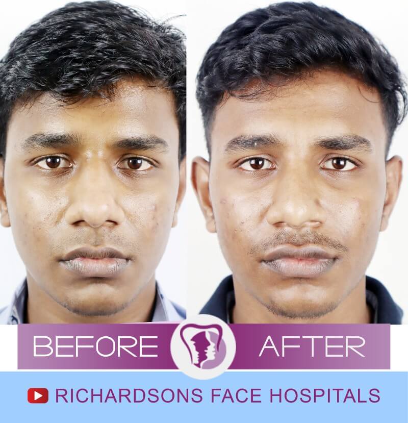Pranav Rhinoplasty Surgery