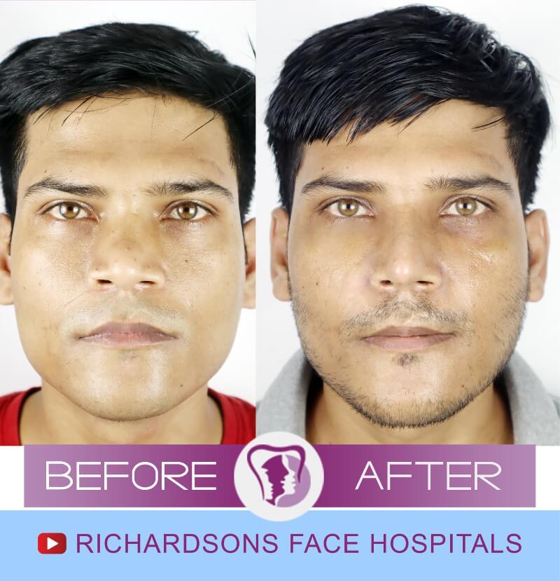 Rajan Singh Rhinoplasty Surgery