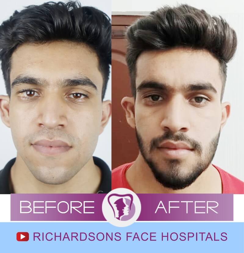 Ratish Facial Asymmetry Surgery
