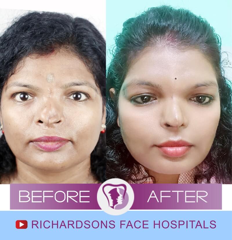 Rhinoplasty Surgery Gauri Kumari