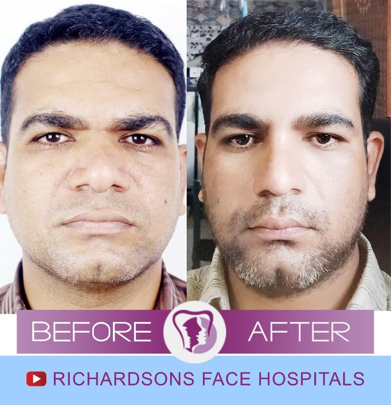Rhinoplasty Surgery Rajesh